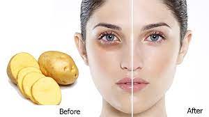 Vì sao nhiều người chọn khoai tây để trị thâm mắt?
